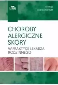 Choroby alergiczne skóry w praktyce lekarza rodzinnego Książki Zdrowie medycyna